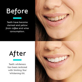 TEETH WHITENING KIT WITH LED LIGHT